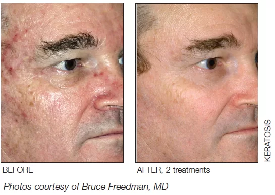 MicroLaserPeel Before and After