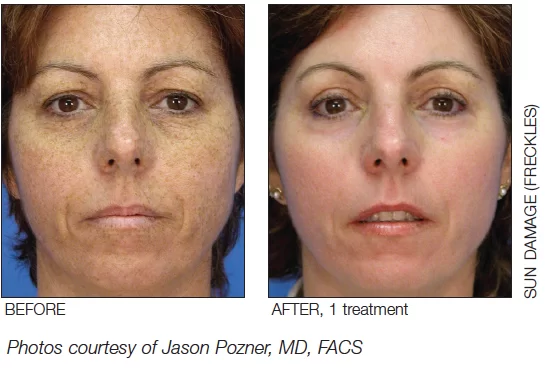 MicroLaserPeel Before and After