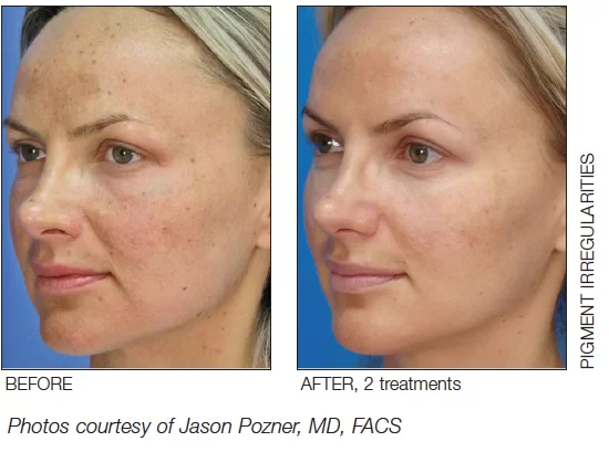 MicroLaserPeel Before and After