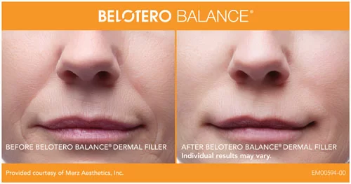 Belotero Balance Before and After