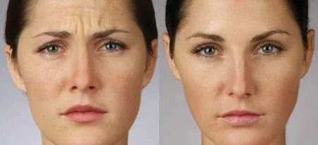 Botox Treatments in Minneapolis, MN
