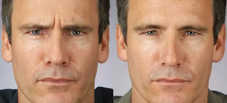 Botox Injections in Minneapolis, MN