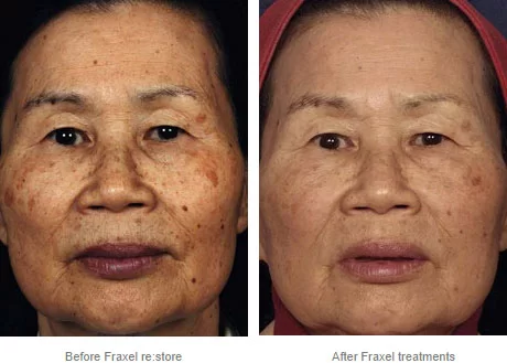 Fraxel re:store™ Laser Treatment Before and After