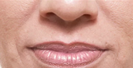 Juvéderm - Before Juvéderm - Before