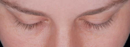 Latisse - Before Treatments Latisse Before Treatments