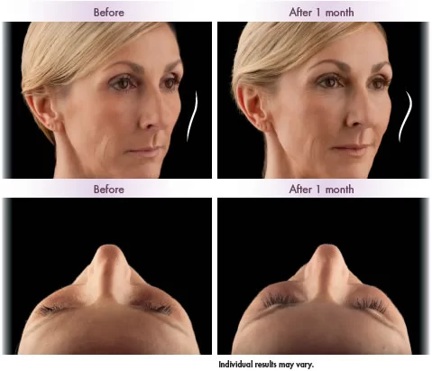 The 20-Second Trick For What Is Juvederm® Ultra Used For? - Spa Black thumbnail