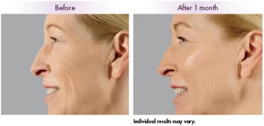 Voluma Before and After