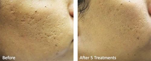microneedling-skinpen-before-and-after dermspec-skinpen2