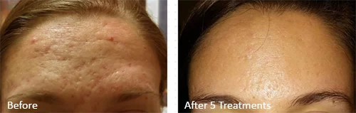 dermspec--skinpen3 dermspec--skinpen3