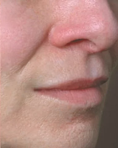 Juvéderm Volbella – After Juvéderm Volbella – After