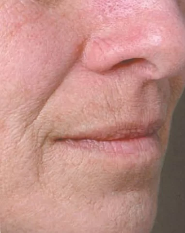 Juvéderm Volbella – Before Juvéderm Volbella – Before