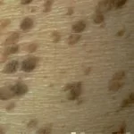 seborrheic keratosis seborrheic keratosis