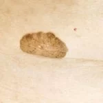 seborrheic-keratosis-3 seborrheic-keratosis-3