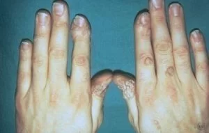 common warts dermatology specialists common warts dermatology specialists