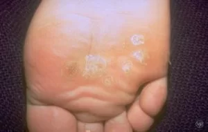 plantar warts dermatology specialists plantar warts dermatology specialists